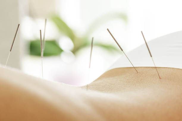 acupuncture back pain