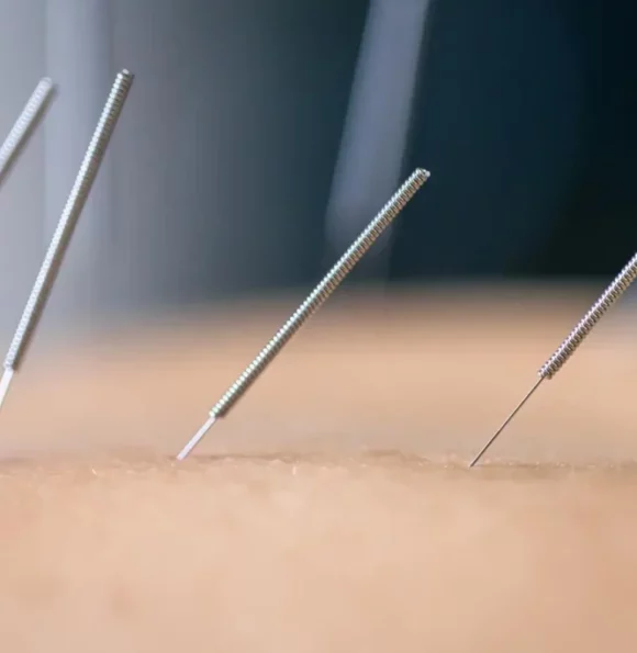 acupuncture mundelein